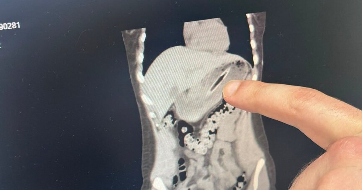 Zayıflamak için kendini kustururken diş fırçası yuttu