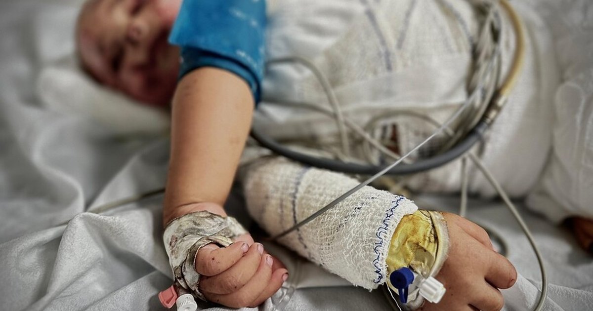 Gazze'de yanık hastaları için tıbbi malzemeler tükenmek üzere