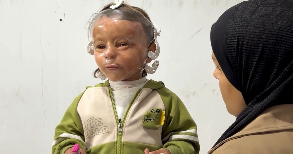 Gazze'de yanık mağdurlarına 3D maske umudu